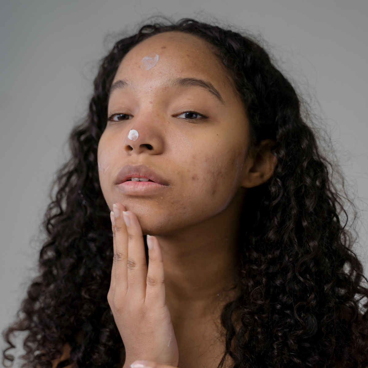 Pielęgnacja cery trądzikowej z KIRE SKIN.