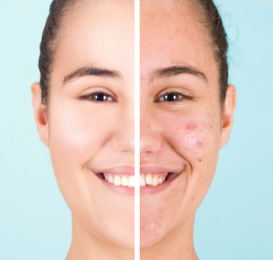 Pielęgnacja twarzy z niedoskonałościami