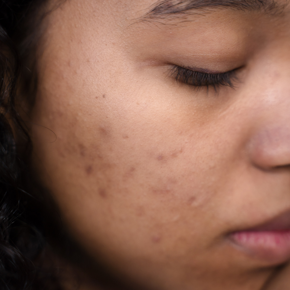 Pielęgnacja skóry trądzikowej z KIRE SKIN. Jak pozbyć się przebawień na twarzy